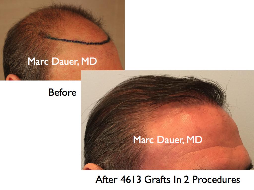 Click image for larger version

Name:	Hair Transplant Slides4.331.jpg

Size:	70.3 KB
ID:	35886