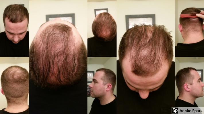 Click image for larger version

Name:	hairline collage.jpg

Size:	33.9 KB
ID:	56504