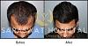 FUE Hair Transplant Results in Agra
