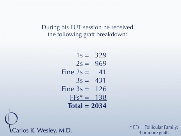 25-year-old male with 2034 FU session with Dr. Carlos K. Wesley for hairline fullness.