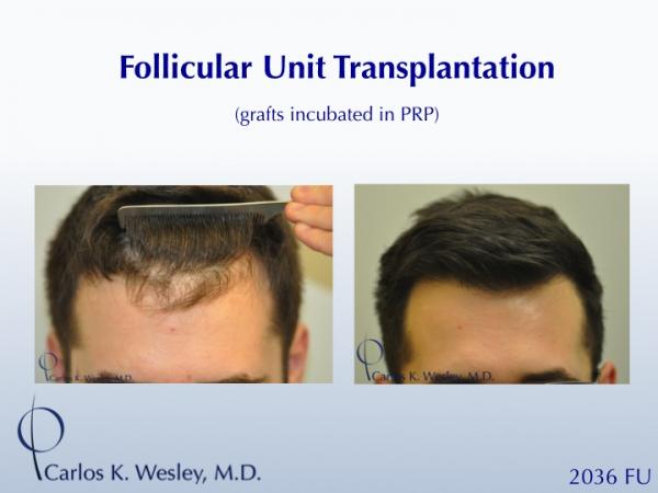 25-year-old male with 2034 FU session with Dr. Carlos K. Wesley for hairline fullness.