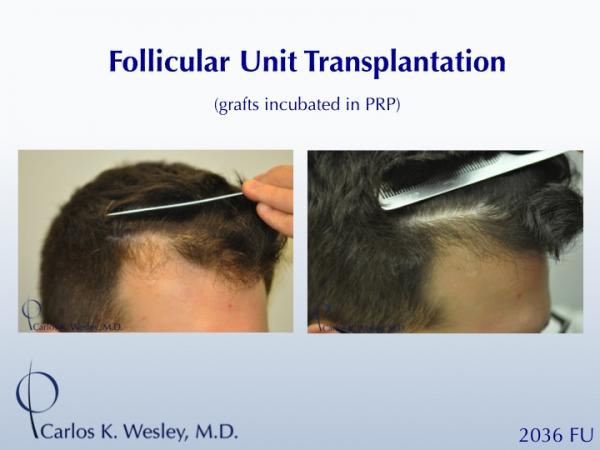 25-year-old male with 2034 FU session with Dr. Carlos K. Wesley for hairline fullness.