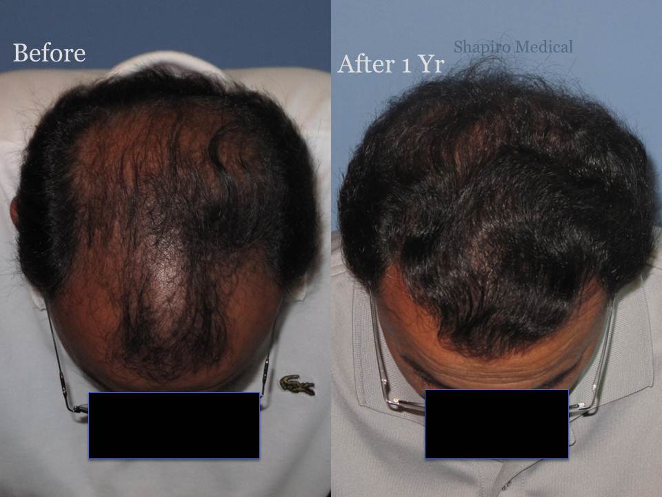 Dr. Paul Shapiro, MD 
FUT 2915 grafts 
12 months post-op