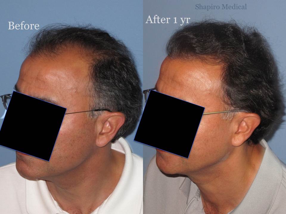 Dr. Paul Shapiro, MD 
FUT 2915 grafts 
12 months post-op