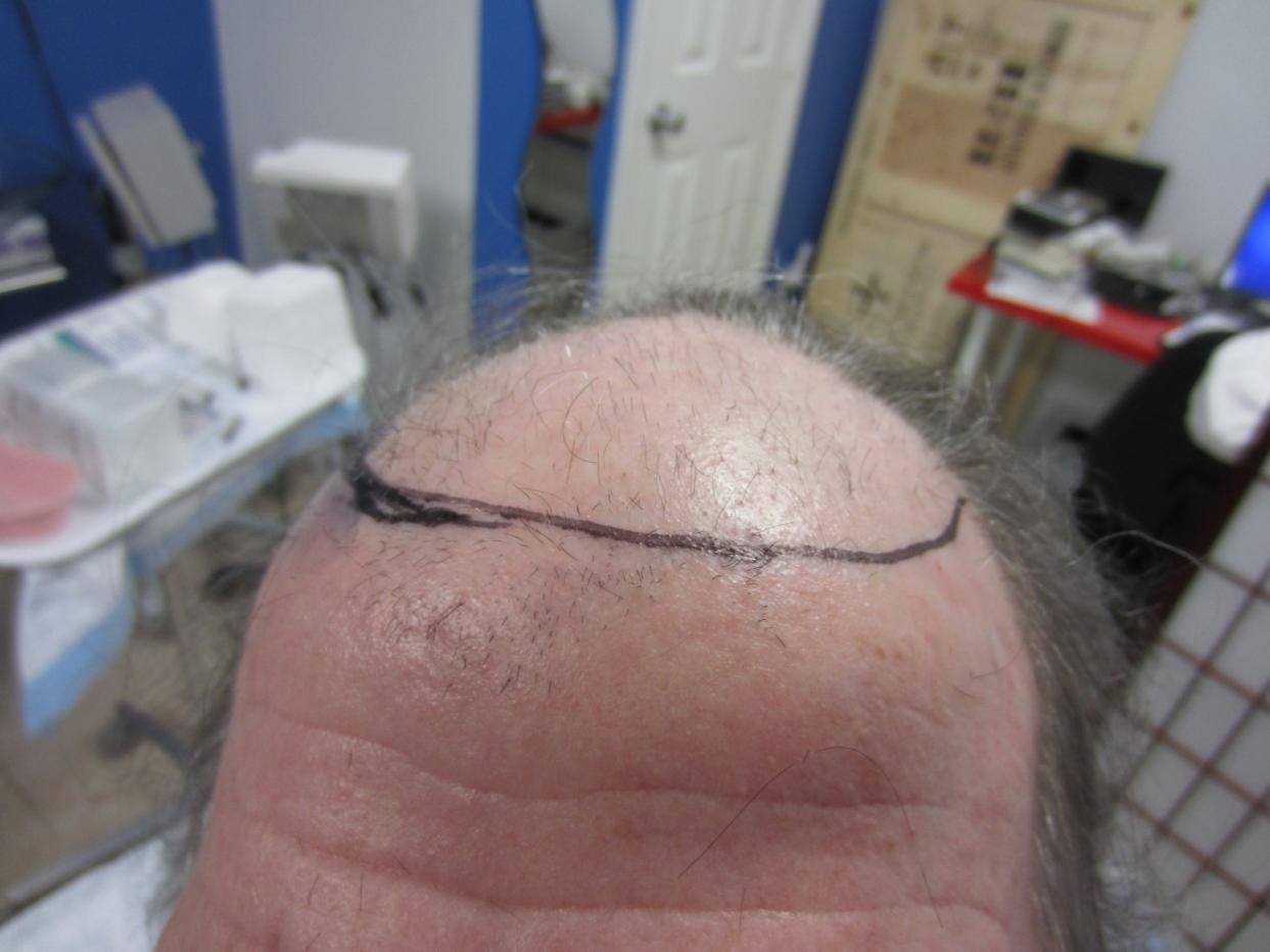 Before Hair Transplant