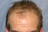 Click image for larger version

Name:	03_before-hair-transplant-top-view.jpg

Size:	55.1 KB
ID:	12695