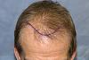 Click image for larger version

Name:	04_position-of-hairline-top-view.jpg

Size:	56.2 KB
ID:	12696