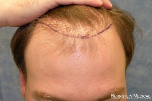 Click image for larger version

Name:	03_hairline-position-after-removal-of-larger-grafts.jpg

Size:	21.1 KB
ID:	18997