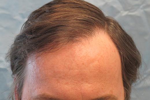 Click image for larger version

Name:	1d-hairline.jpg

Size:	23.9 KB
ID:	35820