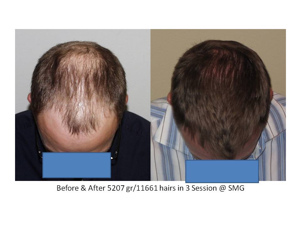 Dr. Paul Shapiro, MD  
FUT  
5207 grafts/ 11,661 hairs 
3 surgical sessions 
12 months post-op session 3