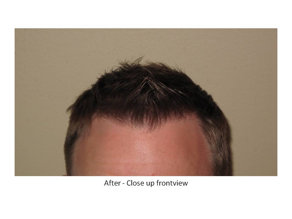 Dr. Paul Shapiro, MD  
FUT  
5207 grafts/ 11,661 hairs 
3 surgical sessions 
12 months post-op session 3