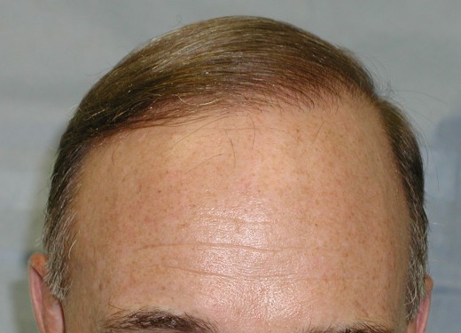 Click image for larger version

Name:	4_after_1st_hair_transplant.jpg

Size:	48.9 KB
ID:	36202