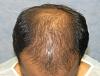 Click image for larger version

Name:	06_before-hair-transplant-top.jpg

Size:	62.4 KB
ID:	6540