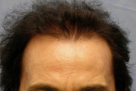 Click image for larger version

Name:	04_after-1st-hair-transplant.jpg

Size:	51.1 KB
ID:	13005