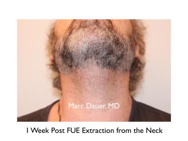 Click image for larger version

Name:	Hair Transplant Slides copy45.005.jpg

Size:	12.8 KB
ID:	46956