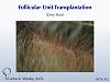 The patient's resultant donor scar after 3976 grafts via FUT with Dr. Carlos K. Wesley 
 
A video of this patient's transformation may be viewed...