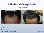 This 43-year-old man desired to reverse the progressive recession of his hairline. A total of 4480 grafts were transplanted to the frontal half of...