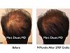 Click image for larger version

Name:	Hair Transplant Slides1.286.jpg

Size:	66.0 KB
ID:	35232