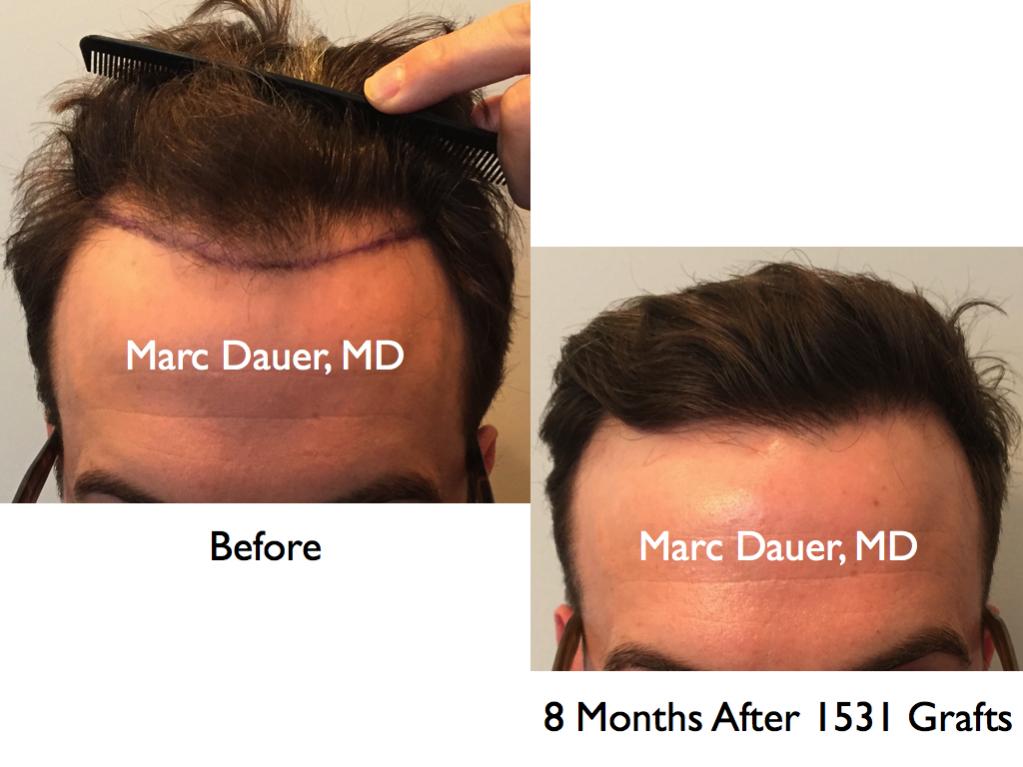 Click image for larger version

Name:	Hair Transplant Slides.735.jpg

Size:	68.7 KB
ID:	41367