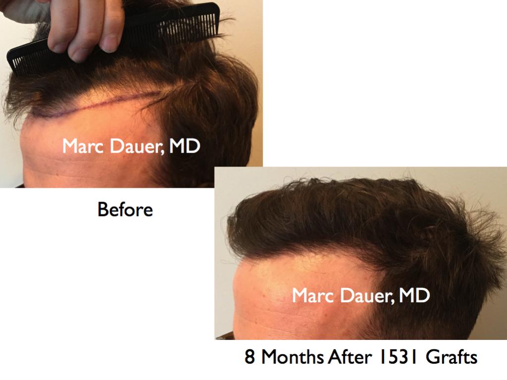 Click image for larger version

Name:	Hair Transplant Slides.736.jpg

Size:	60.7 KB
ID:	41368