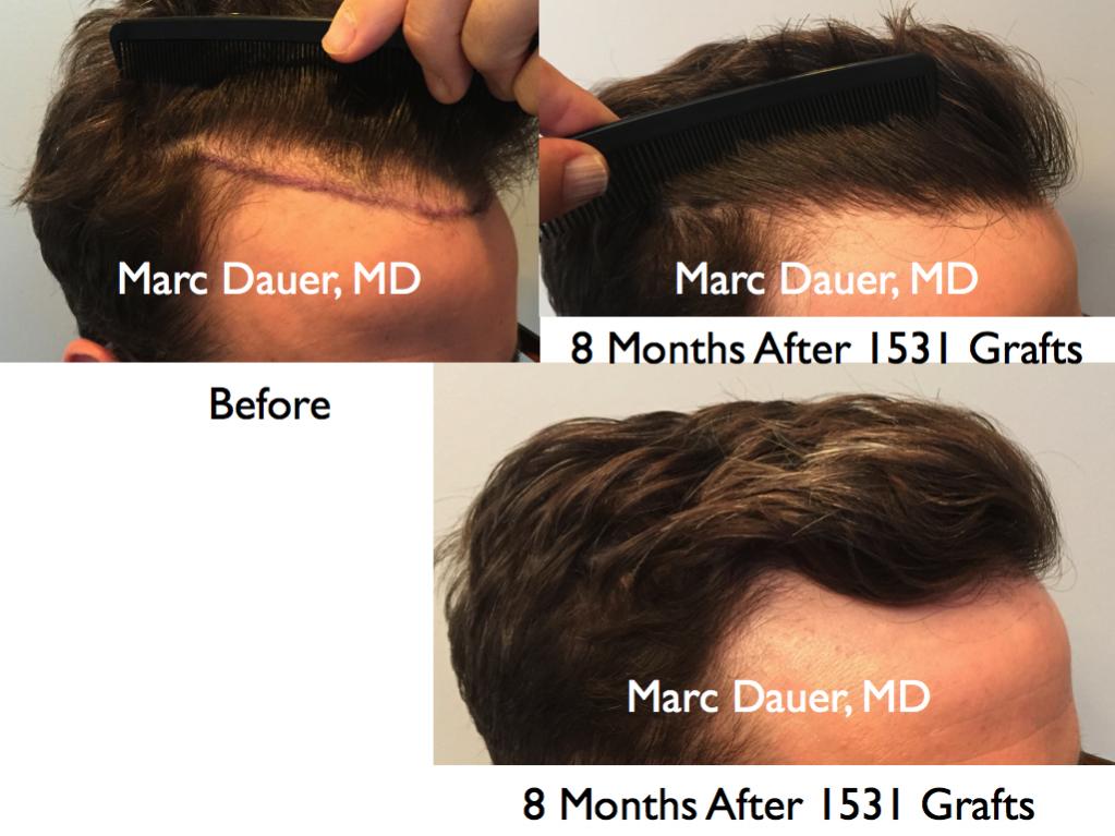 Click image for larger version

Name:	Hair Transplant Slides.737.jpg

Size:	81.7 KB
ID:	41369