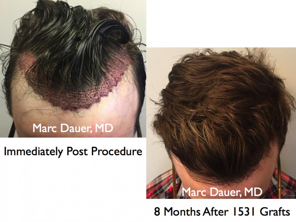 Click image for larger version

Name:	Hair Transplant Slides.738.jpg

Size:	91.5 KB
ID:	41370