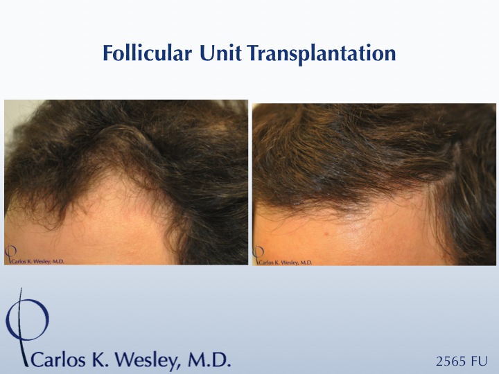 This 32-year-old male is seen before/after a 2565 graft session with Dr. Wesley in NYC. 
 
Interactive before/after images of this patient may be...