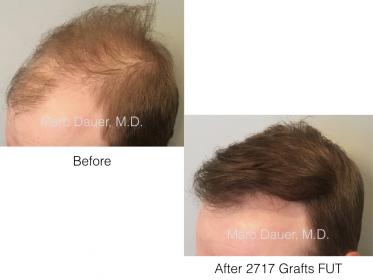 hair transplant patient tof Dr. Marc Dauer