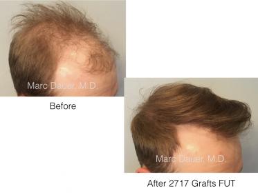 hair transplant patient tof Dr. Marc Dauer