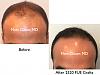 Click image for larger version

Name:	Hair Transplant Slides copy60.001.jpg

Size:	12.3 KB
ID:	46988