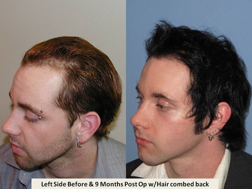 Dr. Paul Shapiro 
FUT 
2631 grafts/4742 hairs 
9 months post-op