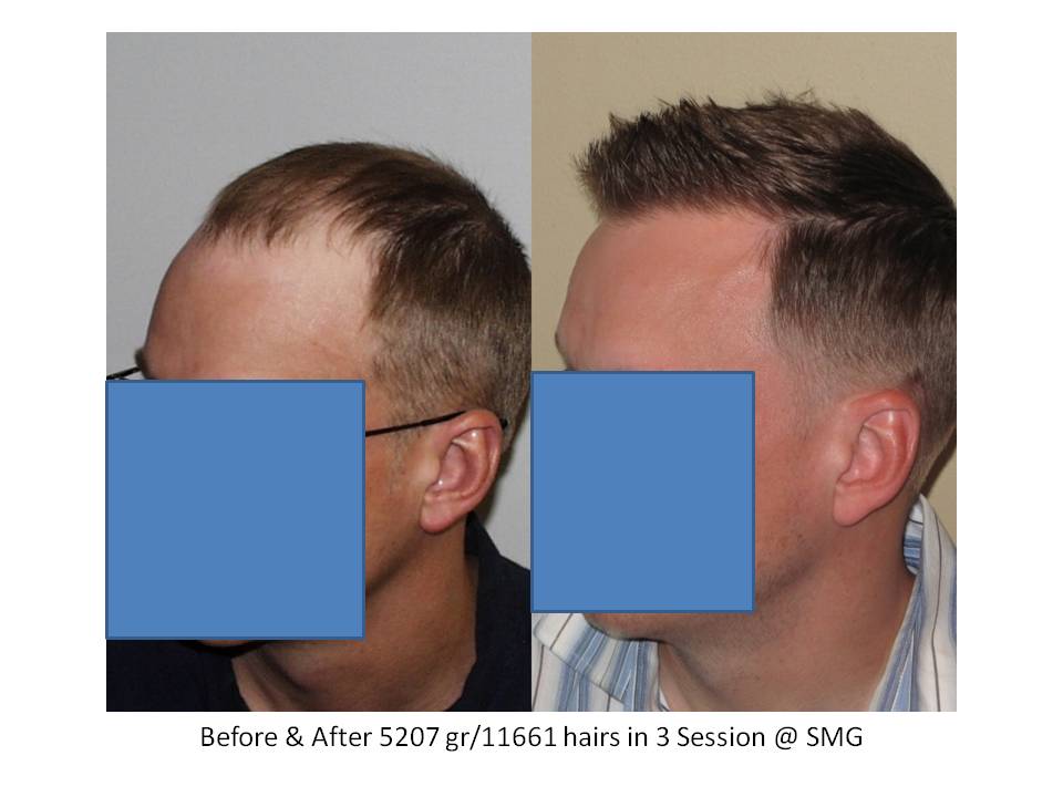 Dr. Paul Shapiro, MD  
FUT  
5207 grafts/ 11,661 hairs 
3 surgical sessions 
12 months post-op session 3