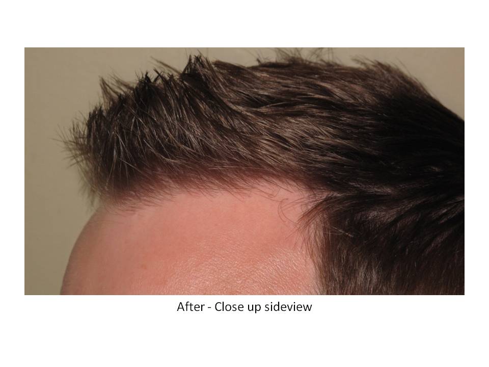 Dr. Paul Shapiro, MD  
FUT  
5207 grafts/ 11,661 hairs 
3 surgical sessions 
12 months post-op session 3