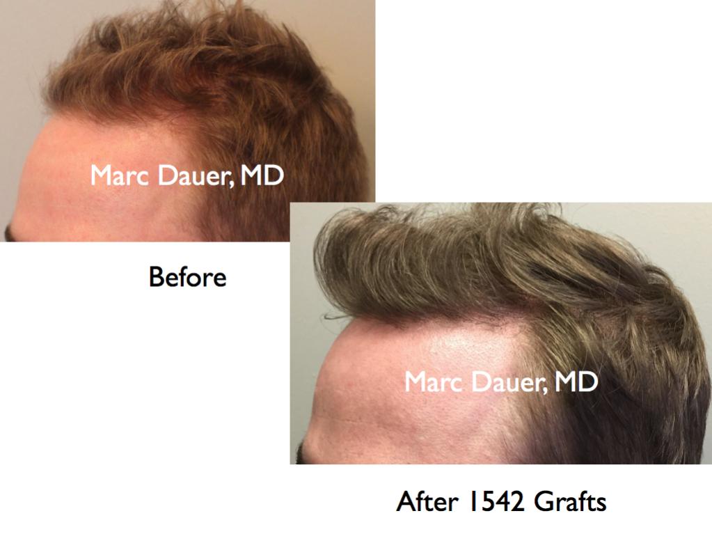 Click image for larger version

Name:	Hair Transplant Slides5.382.jpg

Size:	63.5 KB
ID:	36623