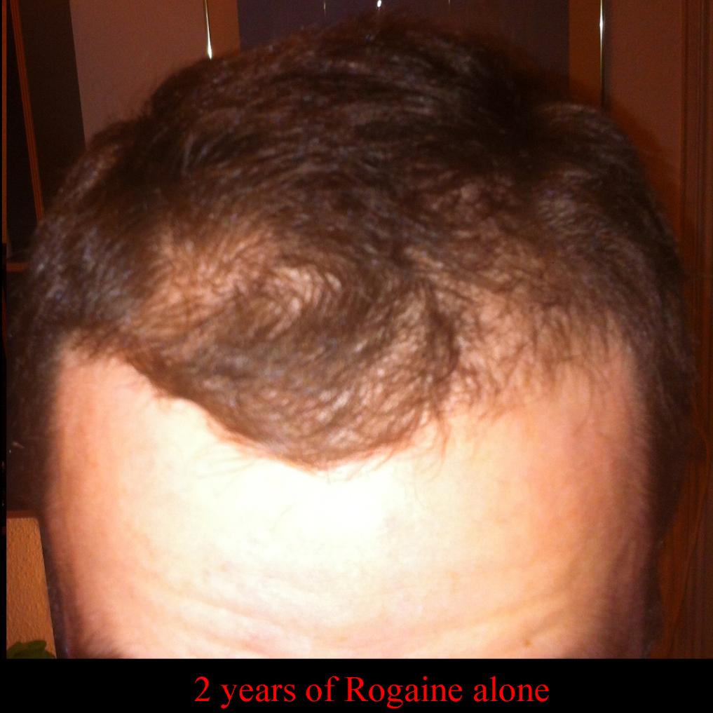 Click image for larger version

Name:	Rogaine_2years.jpg

Size:	83.9 KB
ID:	37458
