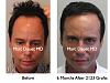 Click image for larger version

Name:	Hair Transplant Slides2.287.jpg

Size:	71.4 KB
ID:	35507