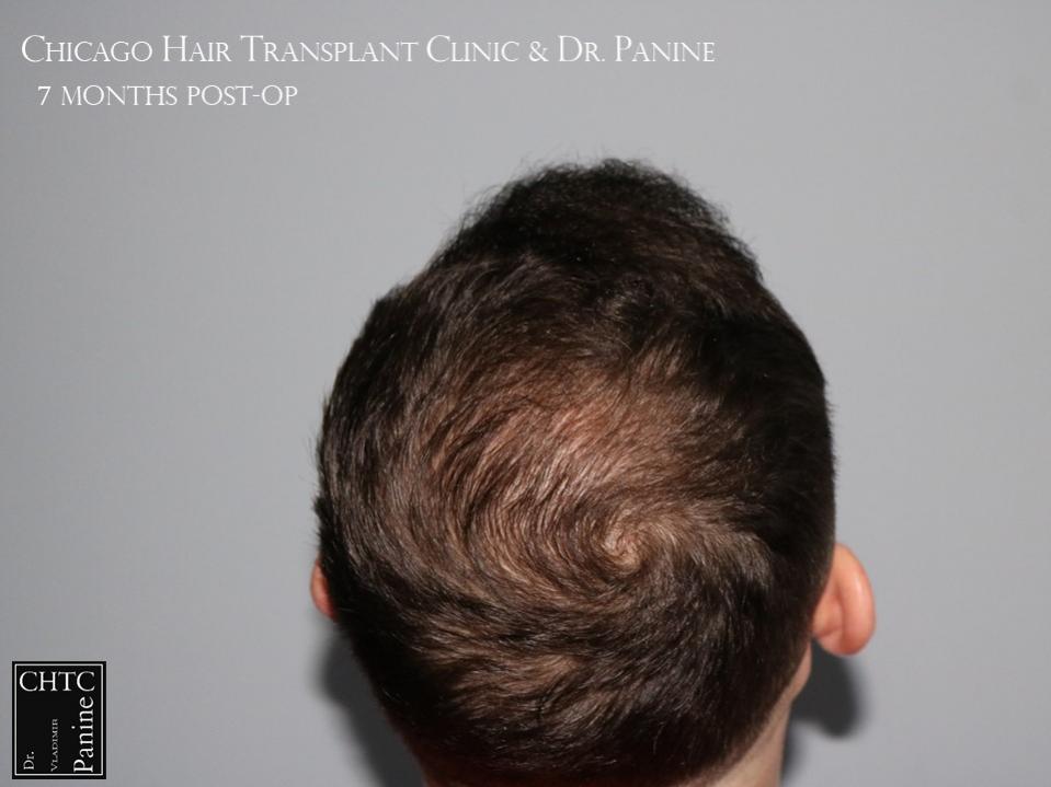 PANINE, MD FUE Hair Transplant Results