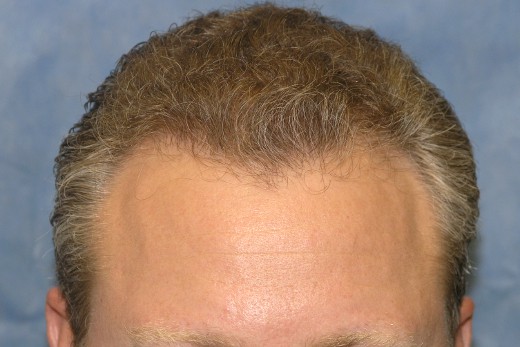 Click image for larger version

Name:	04_after-1st-hair-transplant.jpg

Size:	50.2 KB
ID:	7411