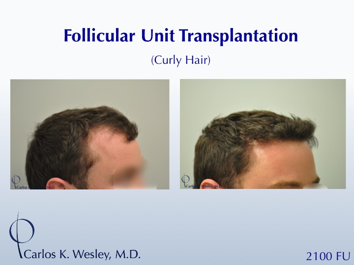 2100 Grafts throughout the frontal half.  The grafts were incubated in PRP prior to transplantation.