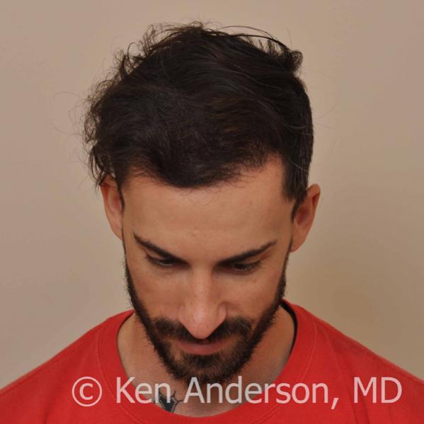 Jason Nicola	 
Norwood 3 
Age: 34 
Surgeon: Dr. Ken Anderson, MD 
Location: Atlanta, Georgia 
	 
Clinical History: 
Jasons initial consultation with...