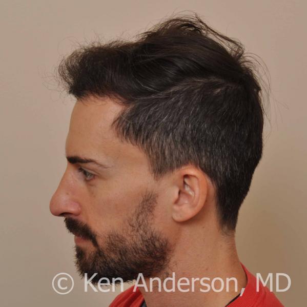 Jason Nicola	 
Norwood 3 
Age: 34 
Surgeon: Dr. Ken Anderson, MD 
Location: Atlanta, Georgia 
	 
Clinical History: 
Jasons initial consultation with...