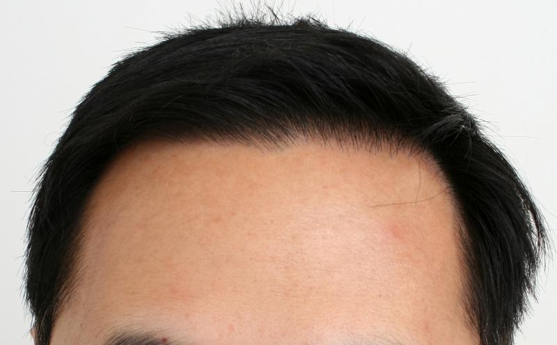 Hairline result after 10 months