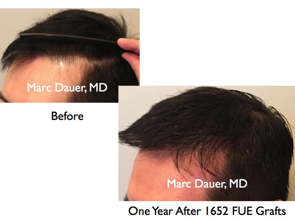 Click image for larger version

Name:	Hair Transplant Slides8.336.jpg

Size:	61.5 KB
ID:	35941