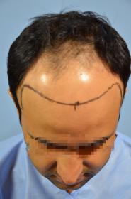 Click image for larger version

Name:	darling buds clinic hair transplant esult at 6 months in Indiia (3).jpg

Size:	8.3 KB
ID:	65983