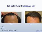 Here is a 42-year-old man who wanted the fullness of his hairline back.  The results of a 2326-graft session with Dr. Wesley can be seen at 11 months...