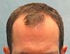 Before Hair Transplant - Detail of Hairline
