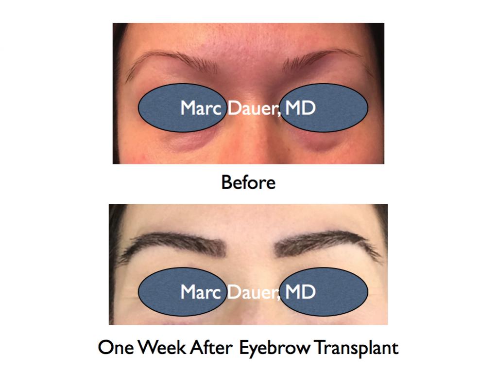 Click image for larger version

Name:	Hair Transplant Slides.672.jpg

Size:	55.2 KB
ID:	40761