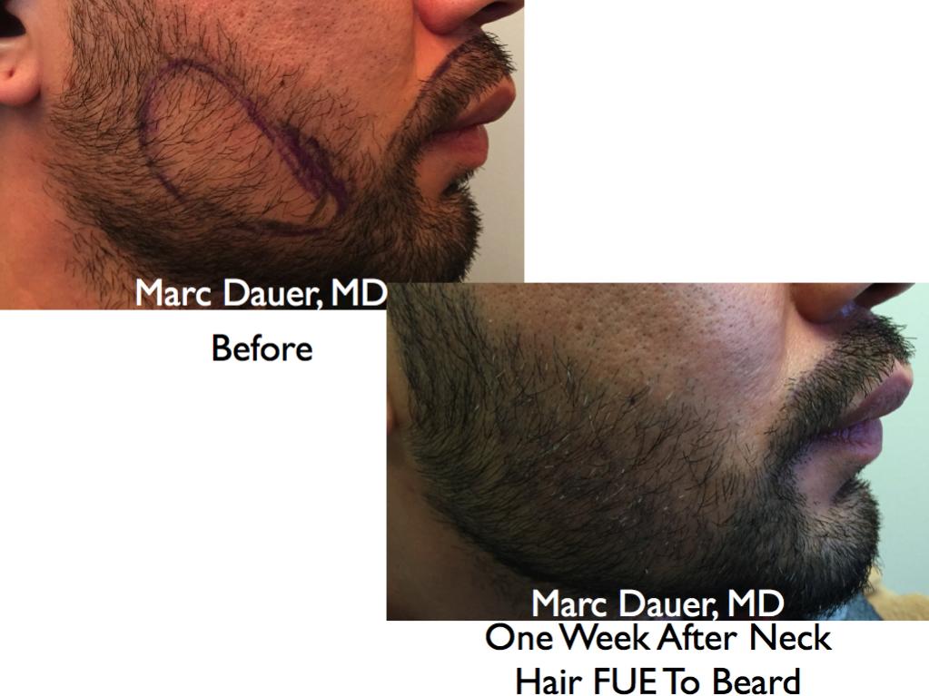 Click image for larger version

Name:	Hair Transplant Slides2.377.jpg

Size:	75.3 KB
ID:	36565