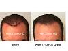 Click image for larger version

Name:	Hair Transplant Slides copy1111.001.jpg

Size:	12.7 KB
ID:	49410