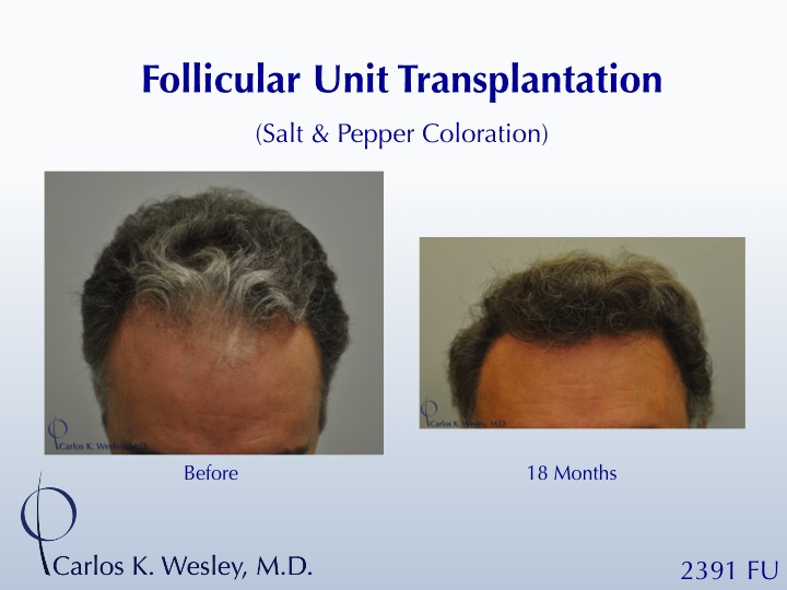 46-year-old male with curly hair of salt & pepper coloration underwent two sessions totaling 4637 FU with Dr. Carlos K. Wesley (NYC).